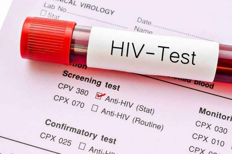 آزمایش hiv چیست + آدرس مراکز